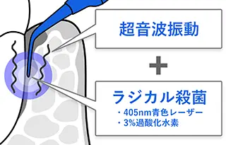 ブルーラジカル治療